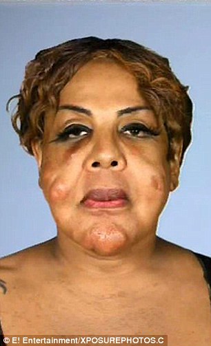 Injected with Cement: Her Unbelievable Transformation