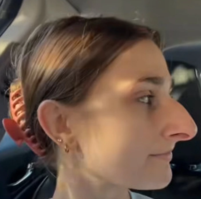 A Woman Shares the Results of Her Plastic Surgery, and the Transformation Has Everyone in Awe